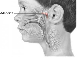 adenoide